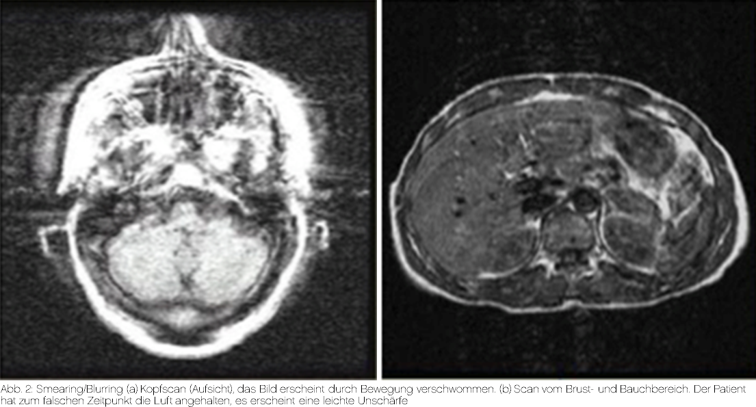 bewegungsartefakte-in-der-radiologie