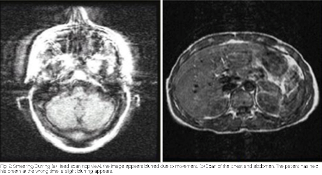 Motion artifacts in radiology